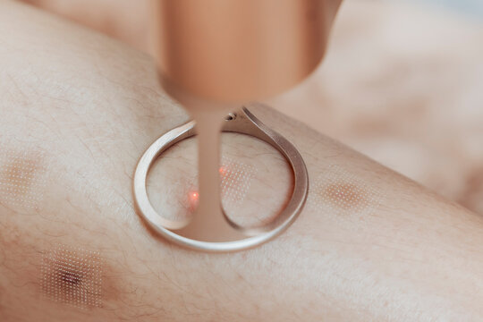 Fractional laser resurfacing treatment on lower leg to improve scars, skin texture and stimulate collagen production with precise laser therapy. Closeup image.