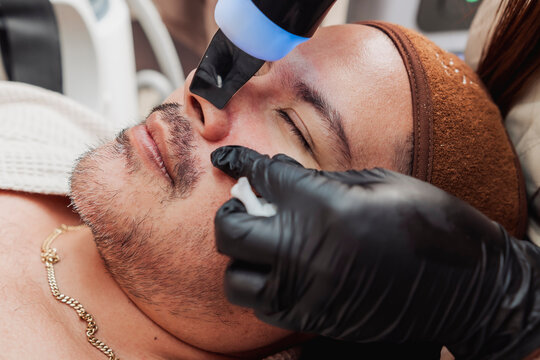 An ultrasonic skin scrubber facial treatment on the nose area of a patient to deeply cleanse pores, exfoliate dead skin, and improve overall skin texture at a professional aesthetic clinic.