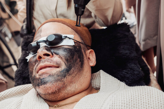 Middle-aged man undergoes a Carbon Laser Facial, also known as the Hollywood Laser Peel, while wearing protective eye shields during a professional skin rejuvenation treatment.