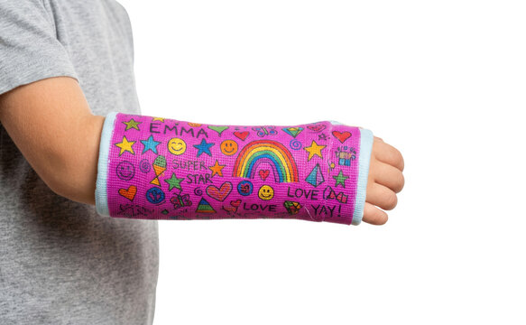 Vibrant purple arm cast, a child's broken arm in a colorful plaster cast, decorated with cheerful drawings and messages, a symbol of childhood injury and recovery isolated on Transparent