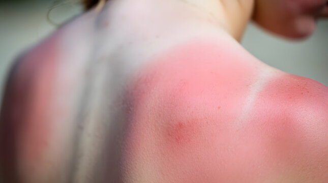 Painful Sunburn on Shoulders After Extreme Heat