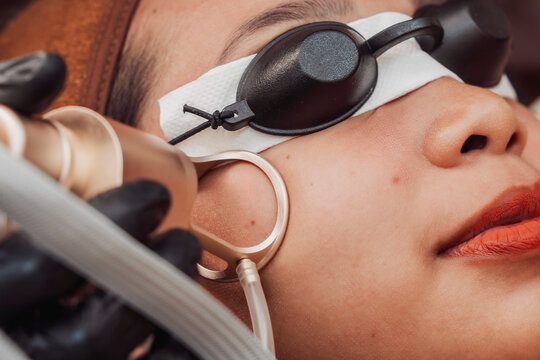 Young Southeast Asian woman undergoes a CO2 fractional laser facial treatment while wearing protective eye shields during a professional skin resurfacing procedure at a medical aesthetic clinic.