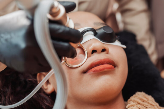 Young Southeast Asian woman undergoes a CO2 fractional laser facial treatment while wearing protective eye shields during a professional skin resurfacing procedure at a medical aesthetic clinic.