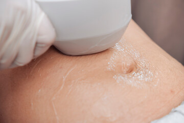 Fototapeta premium Close-up of a non-invasive radio frequency body contouring treatment on the abdomen using an RF applicator for skin tightening and body sculpting in an aesthetic clinic.