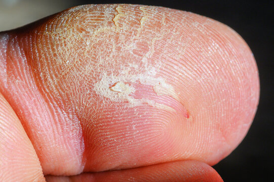 Close-up of dry, peeling skin on a foot or toe with visible irritation