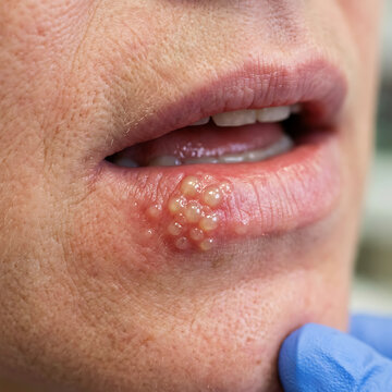 Close-up of mouth with blisters on lips