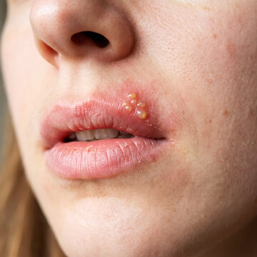 Close-up of mouth with fluid-filled blisters on lips