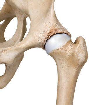 Femoroacetabular impingement hip joint isolated medical 3D anatomy render showing restricted motion, bone overgrowth and acetabular rim contact for orthopedic education and healthcare design use
