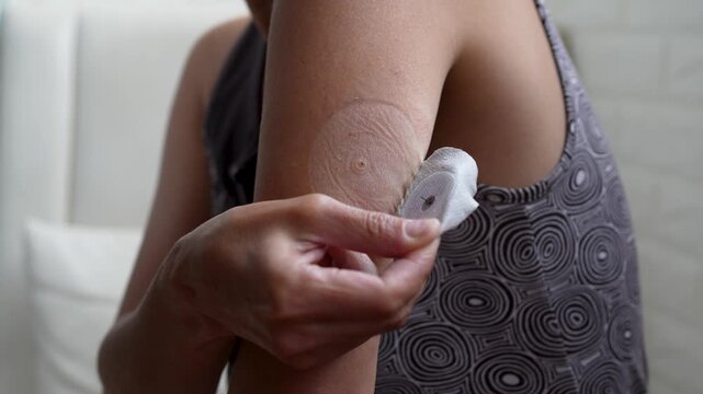 Close up of a woman hands removing a round adhesive plaster from a continuous glucose monitoring CGM sensor on her upper arm, managing diabetes healthcare at home