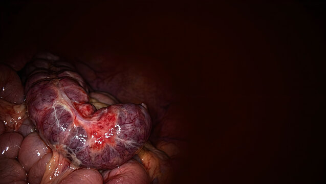 Abdominal exploration reveals a segment of affected bowel with vibrant red and purple hues
