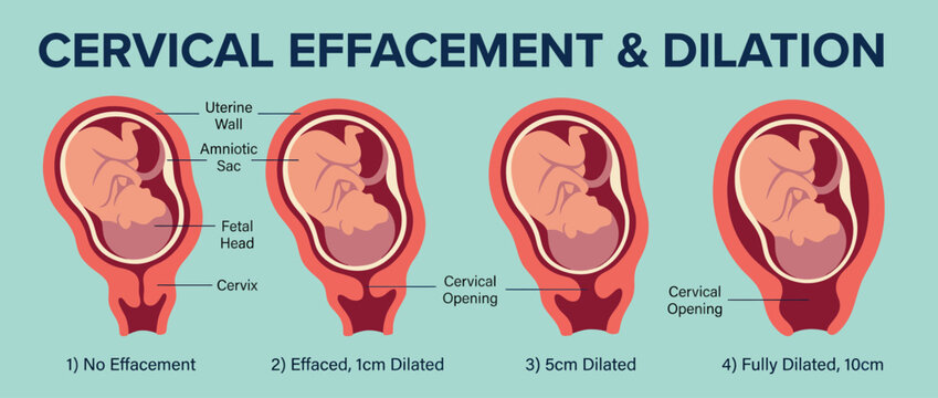 An educational illustration depicting cervical effacement and dilation stages during labor, crucial for understanding childbirth and prenatal education.
