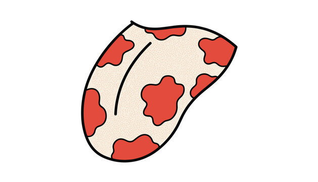 Anatomical drawing depicts geographic tongue condition characterized by irregular red patches on the surface.