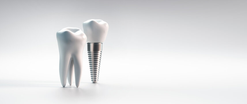 Dental implant and molar tooth isolated on white background with copy space - 3D illustration