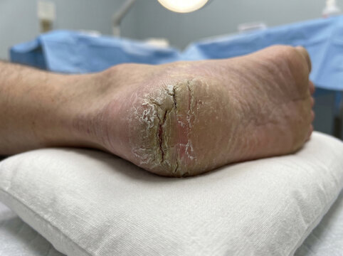 Severe cracked heel with deep painful skin fissure resting on clinic pillow