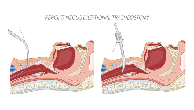PERCUTANEOUS DILTATIONAL TRACHEOSTOMY, highlighting key anatomical landmarks and stepwise airway access.