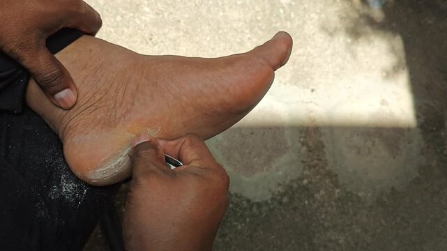 Process of manually scraping dry and hard callused skin on the sole of the foot