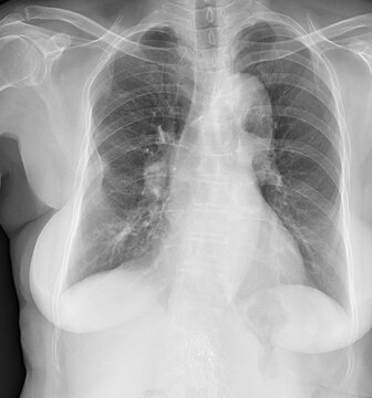 Imaging Follow-up of Endovascular Aneurysm Repair: Assessing Stent-Graft Integrity.