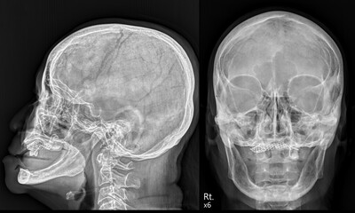 Radiographic Evaluation of Hard Palate Reconstruction: Postoperative Assessment of Mesh Placement © Songkiat