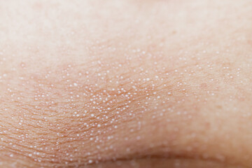 Fototapeta premium Macro close up of sweat droplets on human skin texture, perspiration pores or heat rash condition, medical and wellness concept