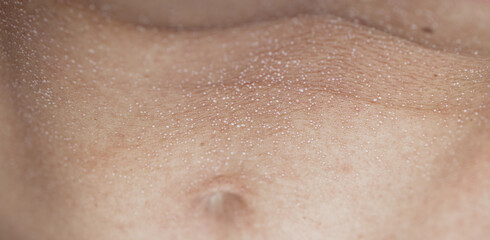 Fototapeta premium Macro close up of sweat droplets on human skin texture, perspiration pores or heat rash condition, medical and wellness concept