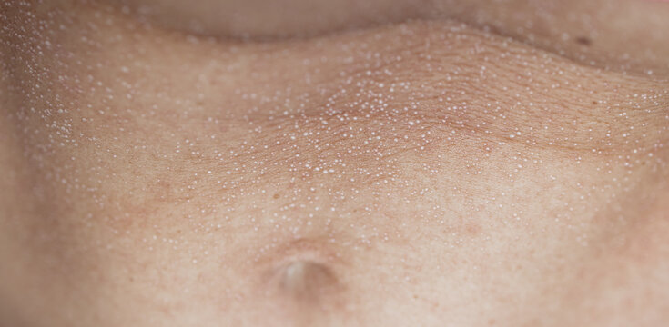 Macro close up of sweat droplets on human skin texture, perspiration pores or heat rash condition, medical and wellness concept