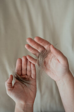 Women's hands with a huge amount of hair loss. Clumps of hair on the hands, the problem of baldness