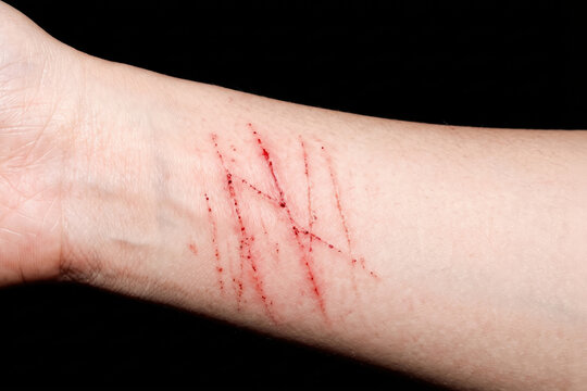 Red scratches bleeding on human wrist skin, self-harm forearms cut wound