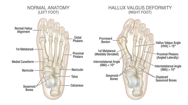Anatomical comparison of normal human foot and hallux valgus bunion deformity
