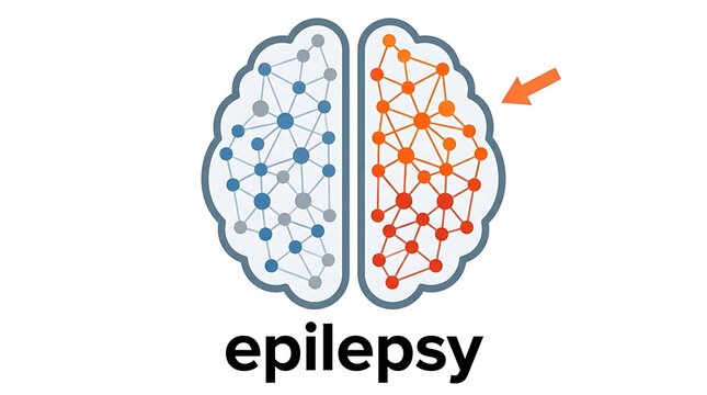 Illustrated brain hemispheres highlighting epilepsy neural activity with arrow