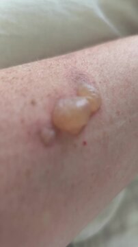 Close-up of large fluid-filled blisters on a human arm. Second-degree burn injury with skin inflammation. Medical dermatology and wound care concept