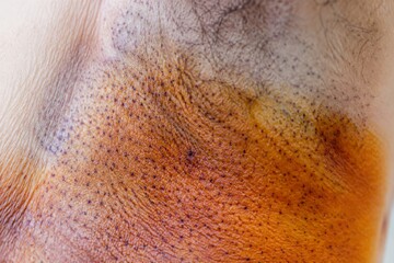 Fototapeta premium Underarm skin with marks after iodine starch test for hyperhidrosis diagnosis. Axillary region prepared for sweating treatment. Medical skin exam for excessive sweat gland activity.