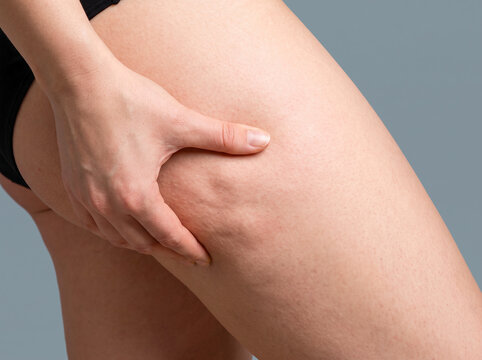 Close-up of a woman's hand pinching the skin on her thigh to show cellulite dimples