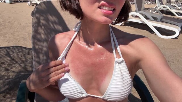 Young woman in white bikini touching severe sunburn on her chest while sunbathing on sun lounger, painful skin redness after sun exposure