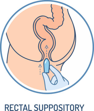 Medical illustration showing how to insert a rectal suppository