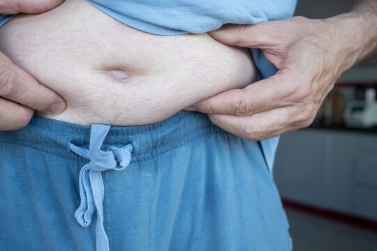 Middle-aged man accumulating abdominal fat due to excessive calorie intake, accumulation of abdominal fat, metabolic disorders, and obesity.