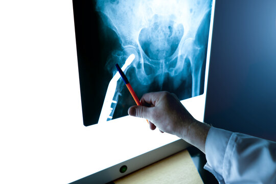 a radiologist examines an X-ray of the hip joint in close-up