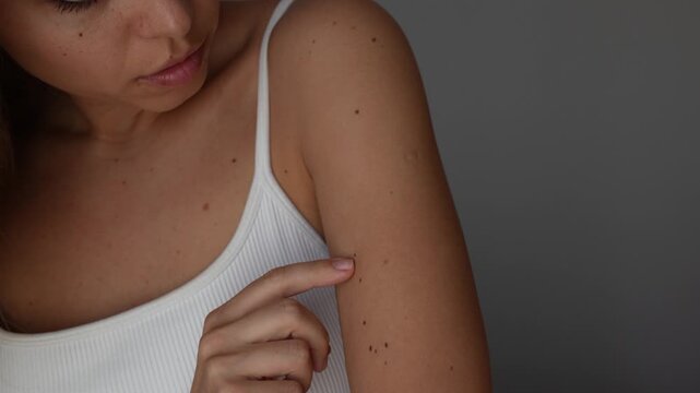 Young woman pointing at multiple moles on her upper arm, showing a large number of skin marks and freckles in a close-up body care and dermatology concept at home on a grey background