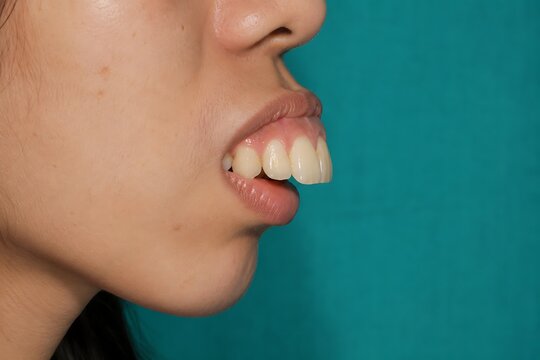 Side profile of overbite teeth with protruding upper jaw and malocclusion, dental correction concept, AI generated