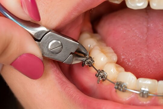 Orthodontist adjusting dental braces on teeth with medical pliers in patient mouth close up generative AI