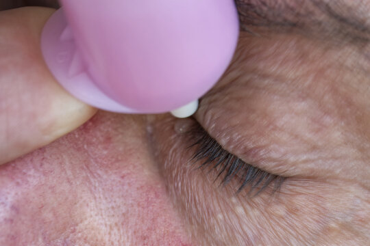 Man applying nourishing eye drops to relieve dry eyes after Intensive computer work, close-up