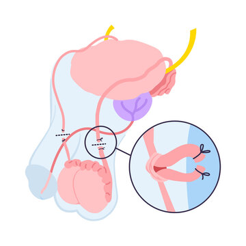 Surgical procedure demonstrates vasectomy reversal connecting tubes.