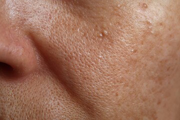 Fototapeta premium Macro Close Up of Whiteheads on Facial Skin