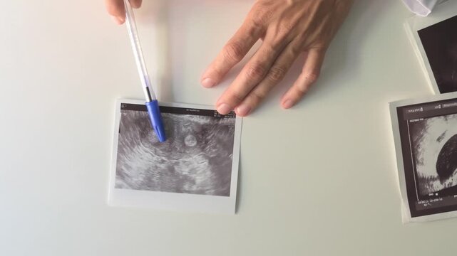 Gynecologist explaining a congenital uterine malformation printout with a pen