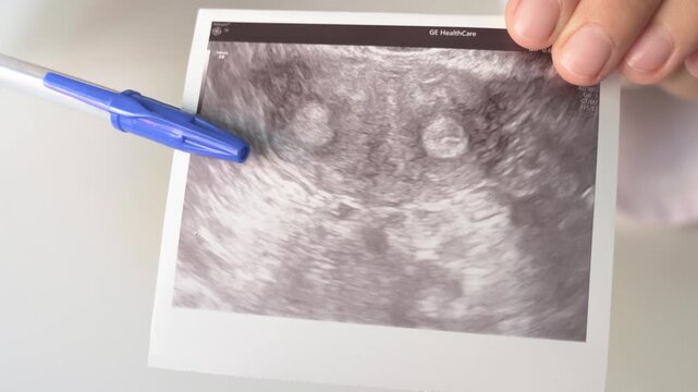 Gynecologist pointing with pen at a congenital uterine malformation sonogram print