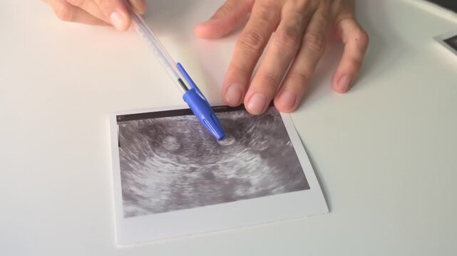 Medical specialist pointing with pen at a septate uterine malformation sonogram