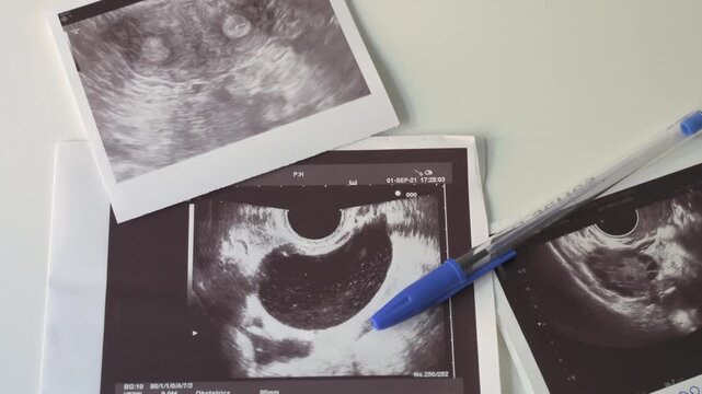 Still life of diverse ovarian cyst and uterine anomaly sonograms on doctor table