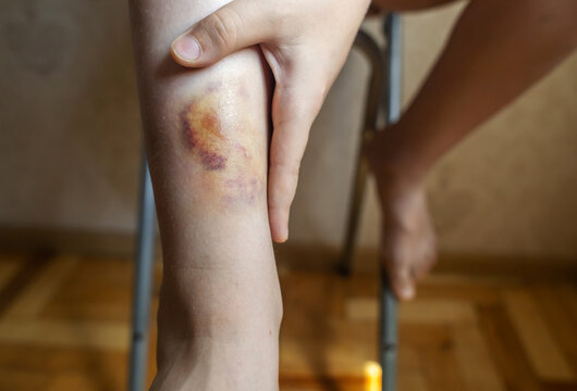 Close up of a large colorful bruise and hematoma on a ten year old boy leg. Child touching painful skin injury on calf after accident, medical healthcare concept.