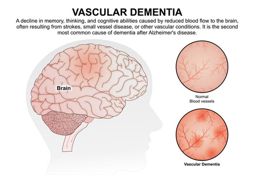 Vascular Dementia, Brain Flashcard Illustration