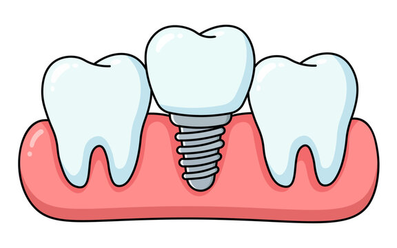 Dental Implant Screw and Natural Teeth Illustration