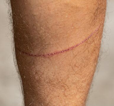 Close-up of healed leg wound on hairy human skin